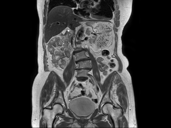 Coronal T2w TSE dS SENSE = 5, MobiView