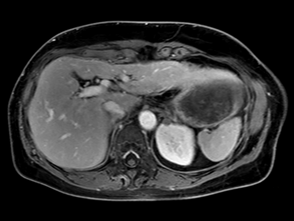 Axial mDIXON – Water (post-gado) dS SENSE = 5.6, MobiView