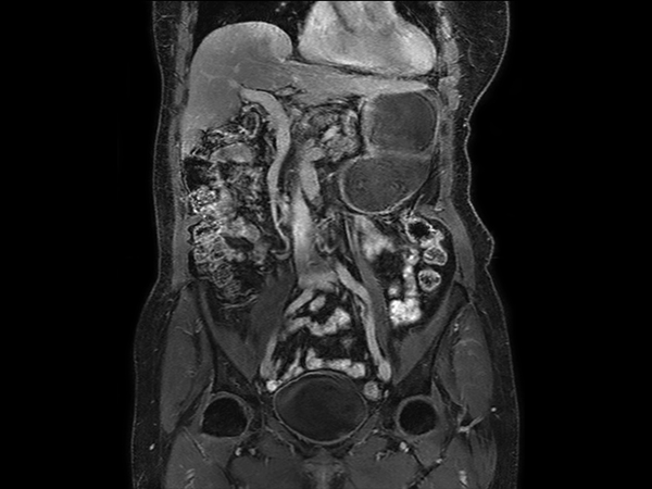 Coronal mDIXON – Water (post-gado) dS SENSE = 6.75
