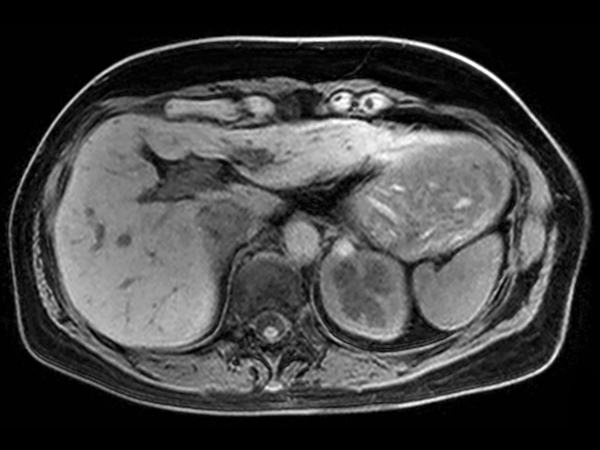 Axial mDIXON – Water (pre-gado) dS SENSE = 6.75, MobiView