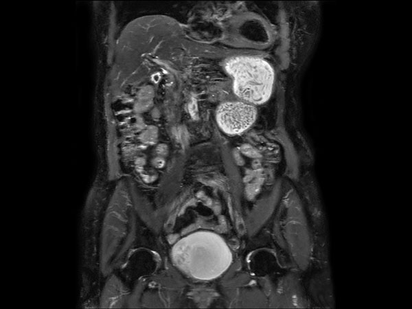 Coronal T2w SPAIR dS SENSE = 5, MobiView