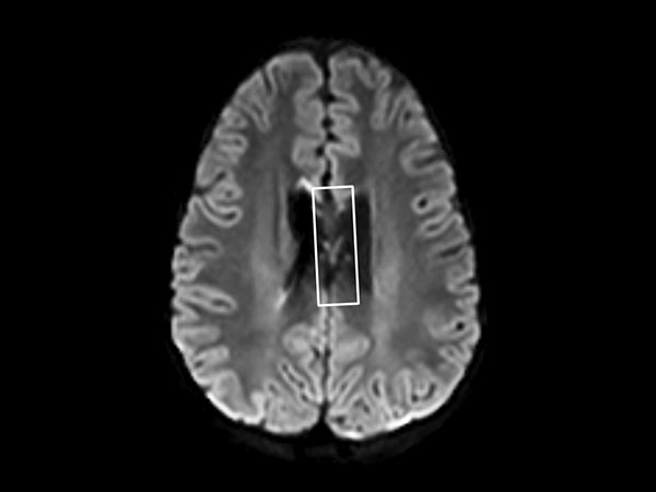 Axial Diffusion (b1000)