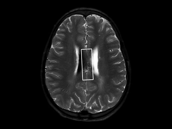 Axial T2w SSh TSE