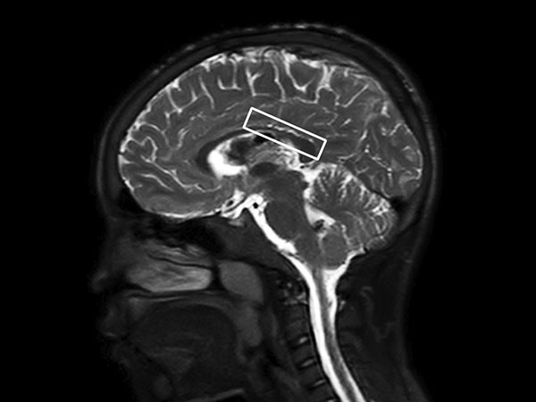 Sagittal T2w SSh TSE