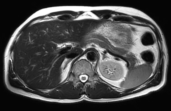 Axial T2w MultiVane XD (fast)