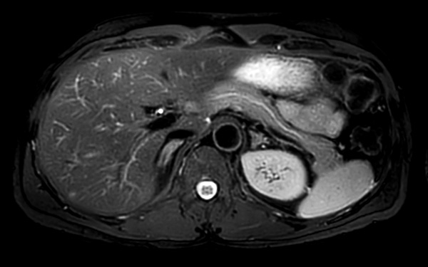 Axial T2w MultiVane XD SPIR (fast)