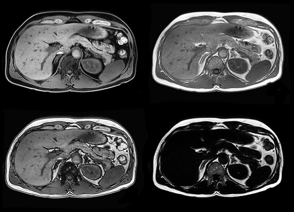 Axial mDIXON (W, IP, OP, F)