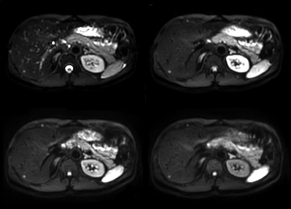 Axial Diffusion (b0, 100, 300, 600)
