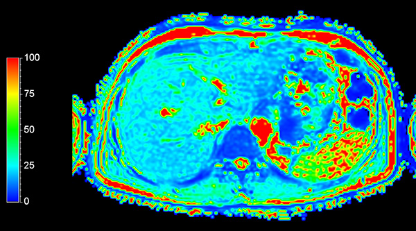 Axial mDIXON Quant (T2*)