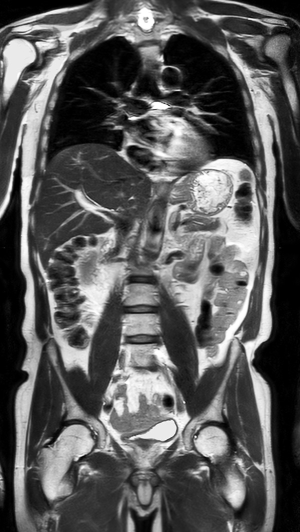 Coronal T2w TSE (MobiView)