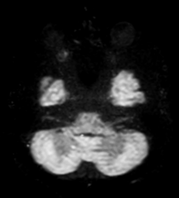 Axial DWI-TSE (b1000)
