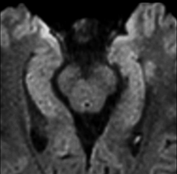 Axial dS Zoom DWI (b1000)