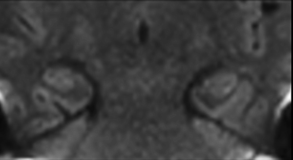 Coronal dS Zoom DWI (b1000)