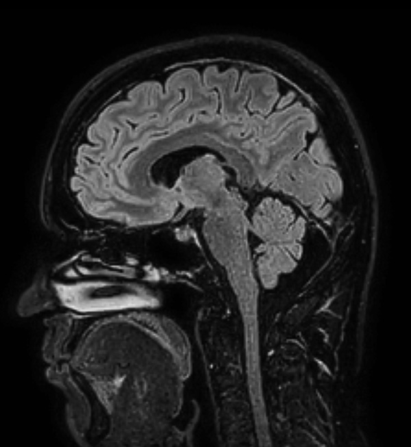 Sagittal 3D BrainView FLAIR