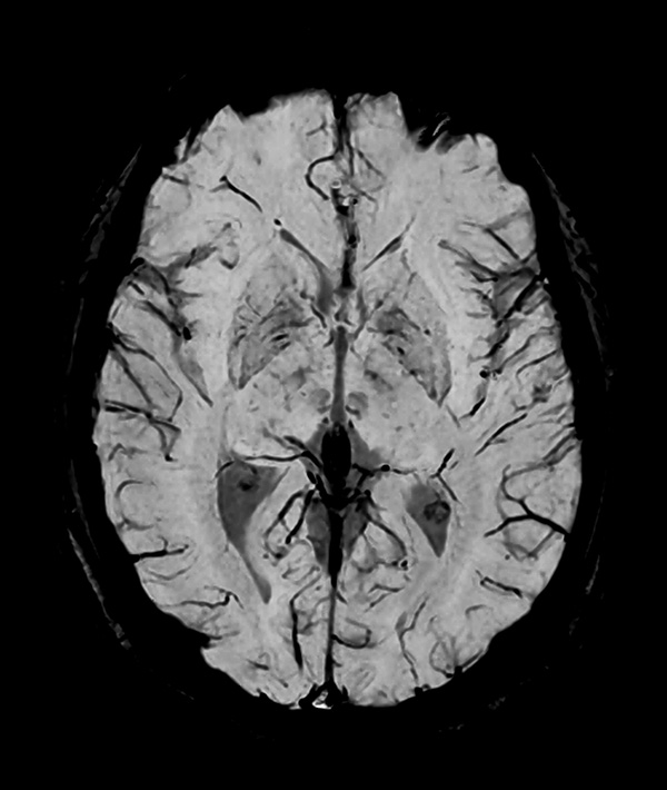 Axial SWIp (minP) (high res)