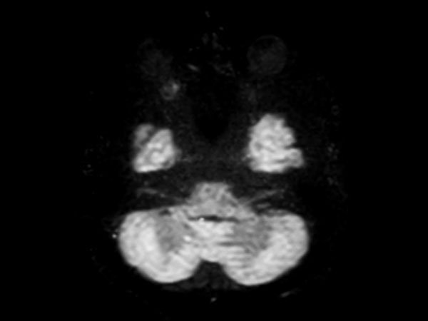 Axial DWI-TSE (b1000)