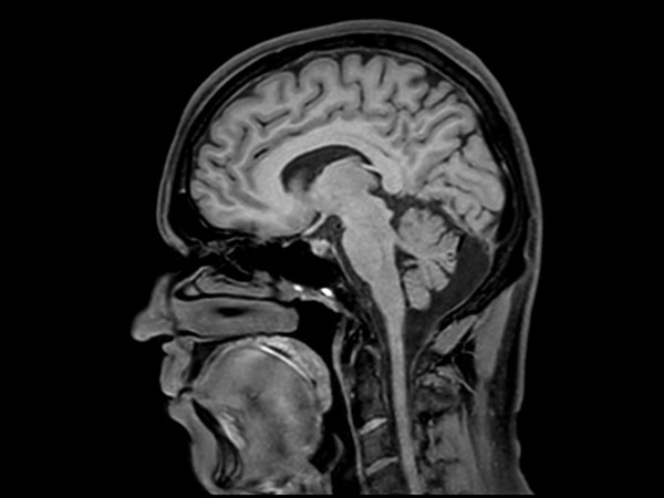 Sagittal 3D T1w TSE