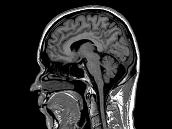 Sagittal 3D T1w FFE