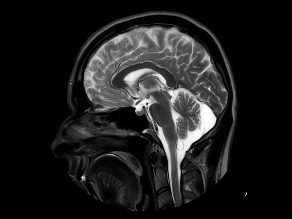 Sagittal T2w MultiVane XD