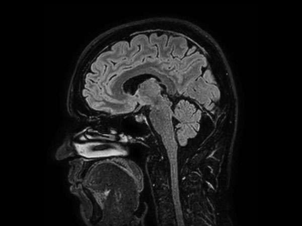 Sagittal 3D BrainView FLAIR