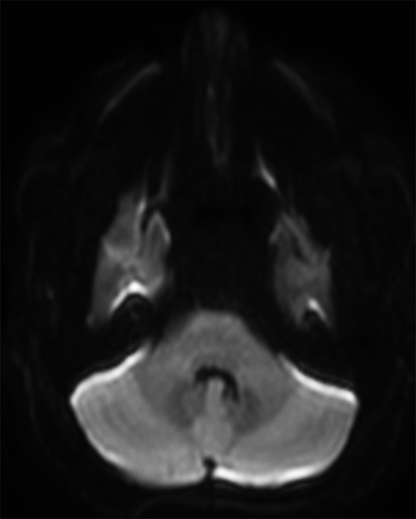 Axial DWI EPI(b1000) (IAC)