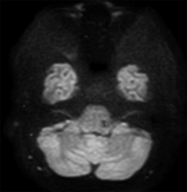 Axial DWI TSE(b1000) (IAC)
