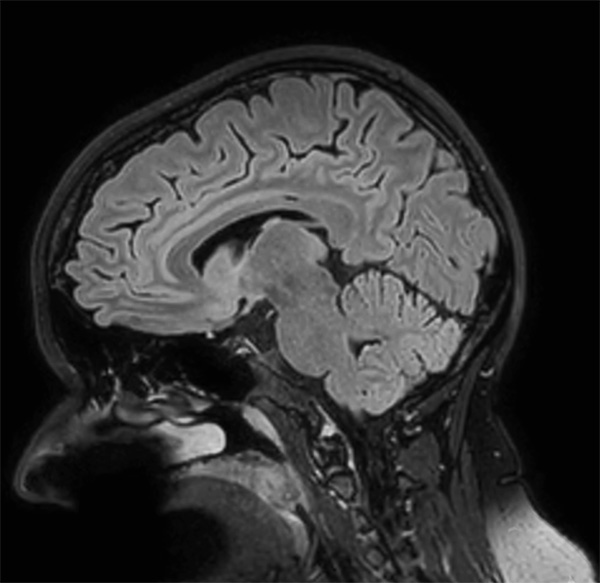 Sagittal 3D BrainView FLAIR