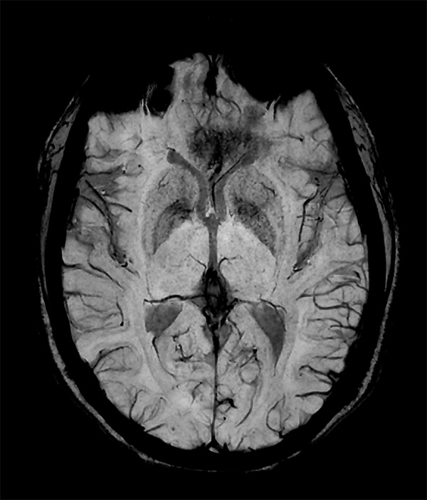 Axial SWIP(minP) (fast)