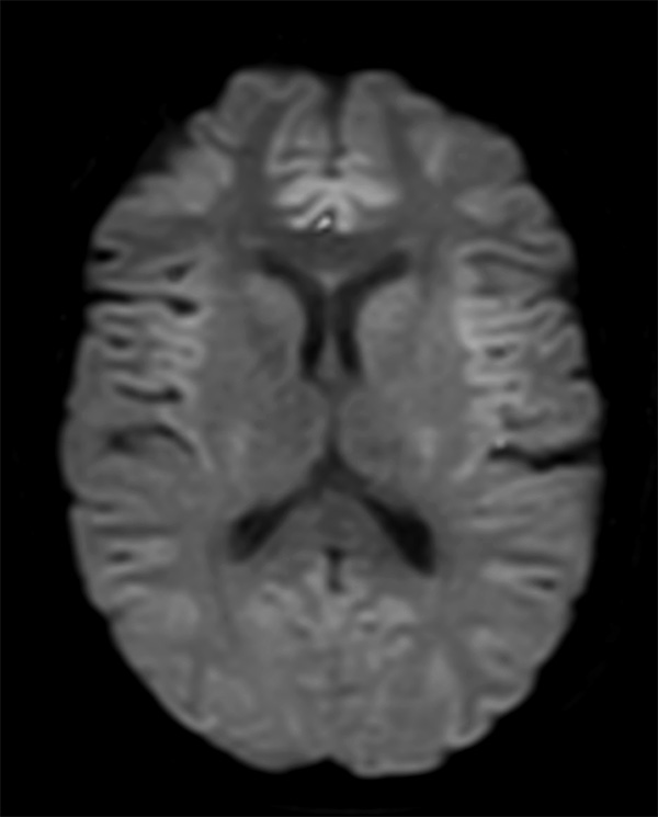Axial DWI TSE(b1000)