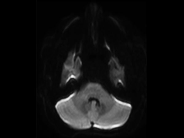 Axial DWI EPI(b1000) (IAC)