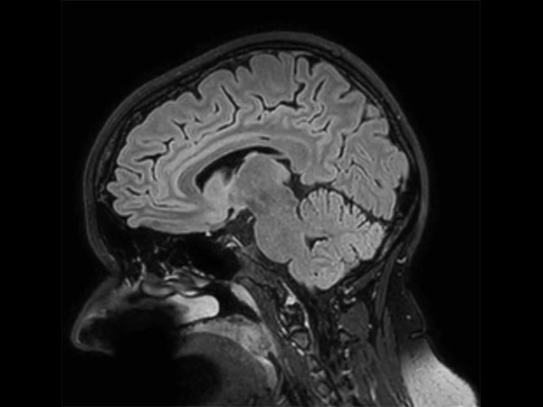 Sagittal 3D BrainView FLAIR