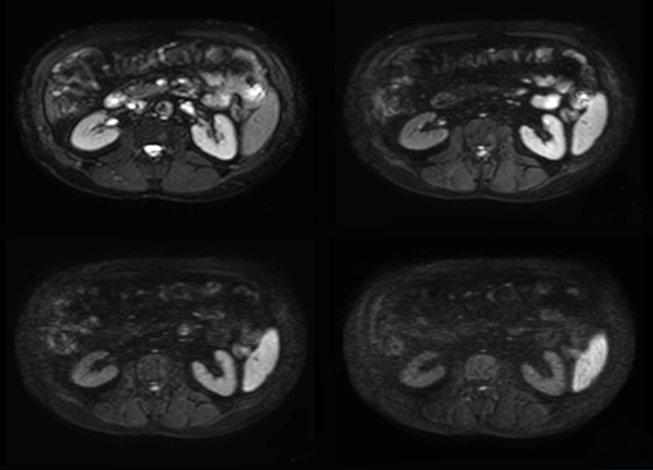 Axial DWI (b0, b150, b400, b800) dS SENSE 3.5