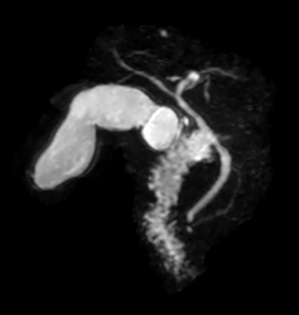 3D MRCP (MIP) dS SENSE 2