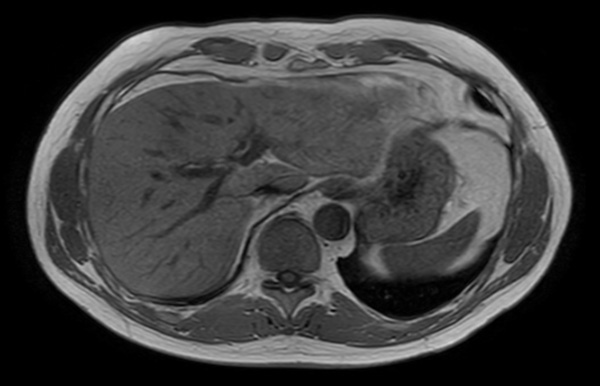 Axial T1w FFE dS SENSE 3