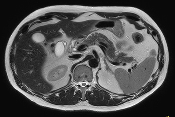 Axial T2w MultiVane XD dS SENSE 2