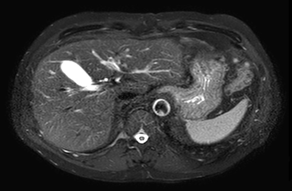 Axial T2w SPAIR dS SENSE 3.5