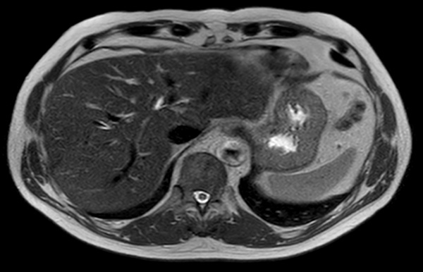 Axial T2w TSE dS SENSE 3