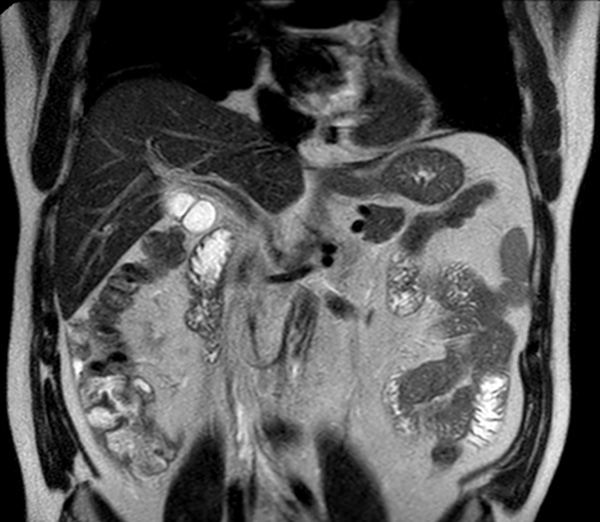 Coronal T2w TSE dS SENSE 4