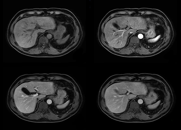 Axial dynamic mDIXON (water only) dS SENSE 4.5