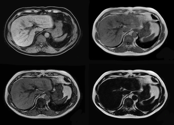 Axial mDIXON (W, IP, OP, F) dS SENSE 6