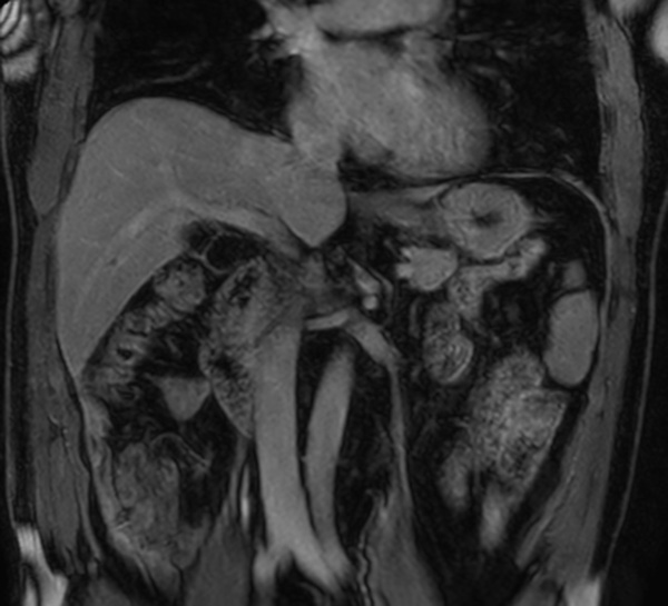 Coronal mDIXON (water only) dS SENSE 4