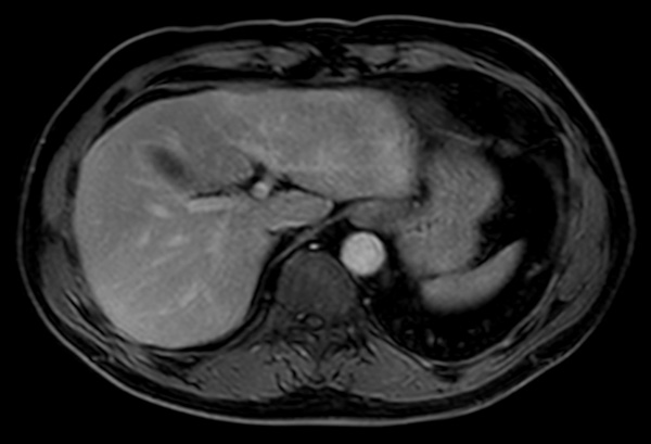 Axial mDIXON (water only) dS SENSE 6