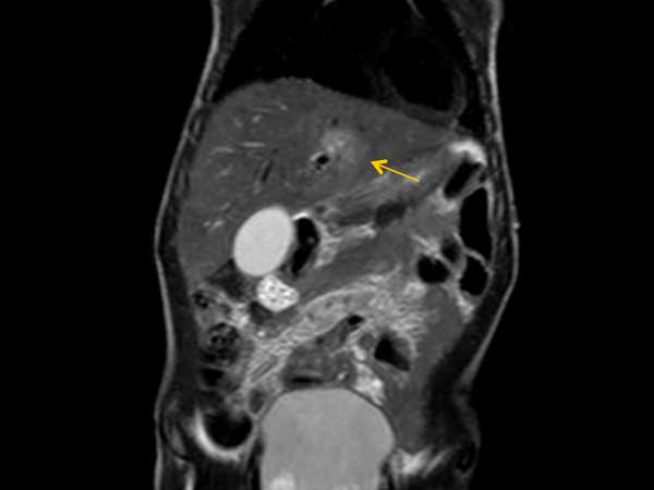 Coronal T2w TSE (with Resp. Navigator)