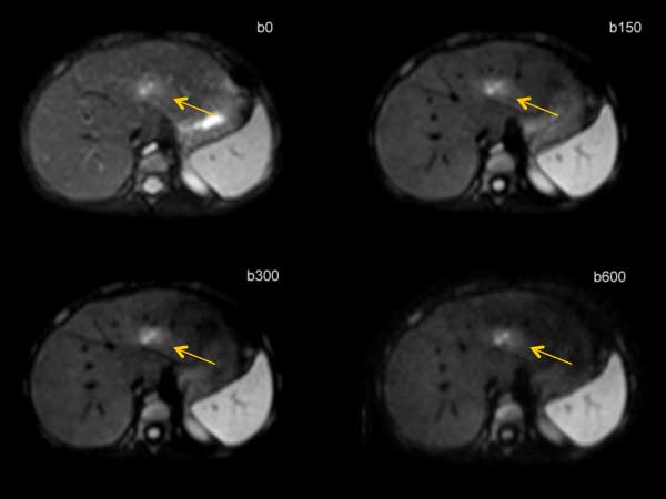 Axial Diffusion (with Resp. Triggering)
