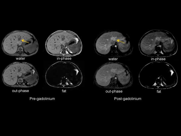 Axial mDIXON (Free Breath)