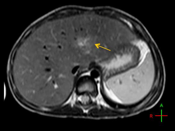Axial T2w TSE (with Resp. Navigator)