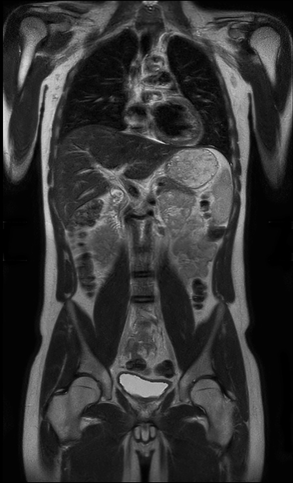 Coronal T2w TSE (MobiView)
