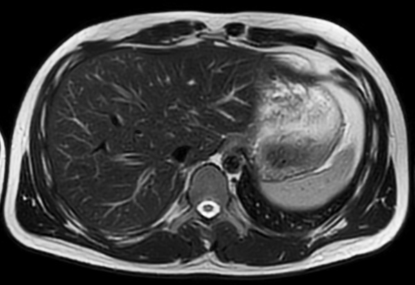 Axial T2w MultiVane XD (fast)