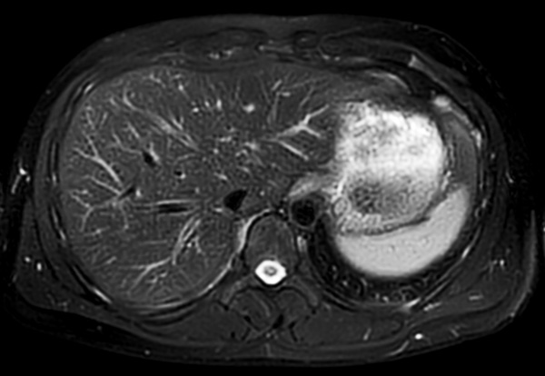 Axial T2w MultiVane XD SPIR (fast)