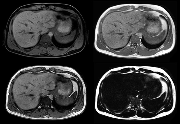 Axial mDIXON (W, IP, OP, F)